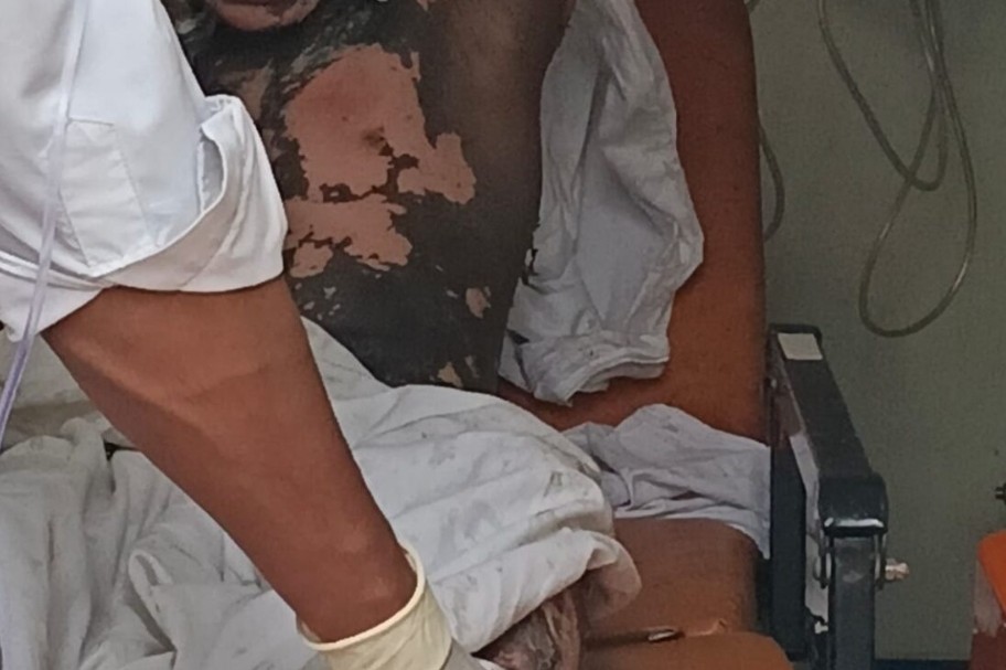 टाटानगर स्टेशन पर खौफनाक हादसा: OHE तार की चपेट में आकर युवक गंभीर रूप से झुलसा